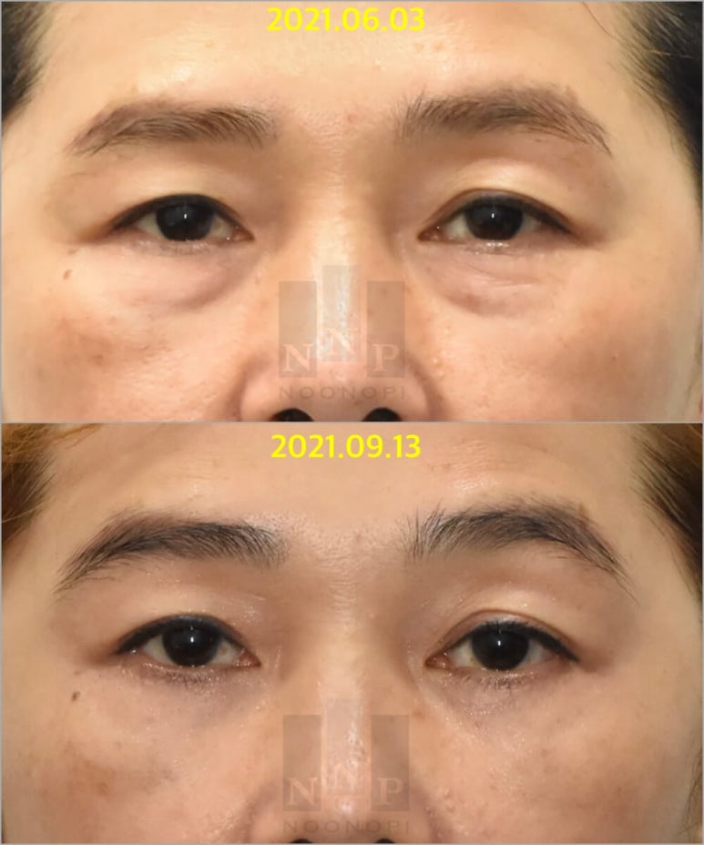 Lower Blepharoplasty vs. Fat Repositioning for Under-Eye Bags - Which Under-Eye Surgery Is Right for Me? image 9