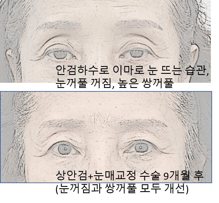 Do I Need Ptosis Correction When Getting Upper Blepharoplasty? image 2