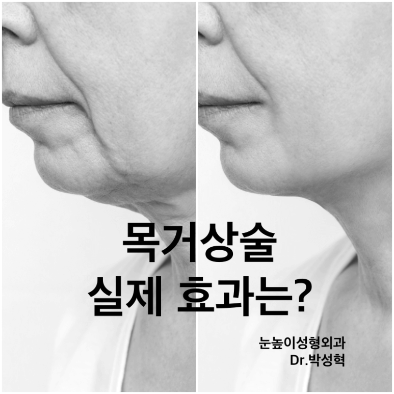 이중턱 치료 : 목거상술의 실제 효과는? 관련 이미지 1