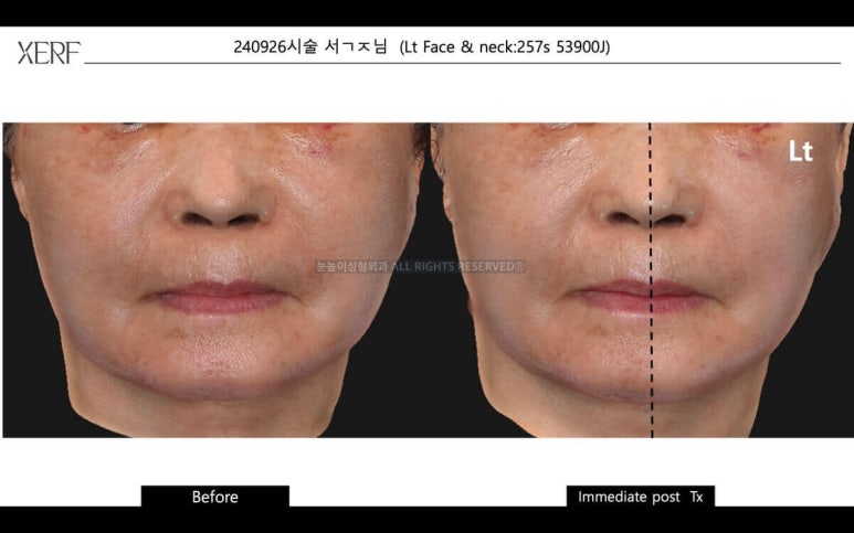 안면거상 후 세르프 리프팅은 언제부터 가능할까 관련 이미지 6