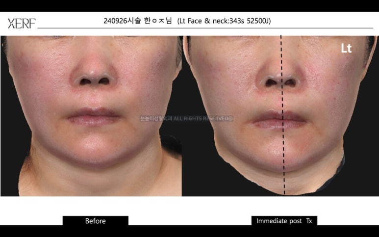 안면거상 후 세르프 리프팅은 언제부터 가능할까 관련 이미지 15