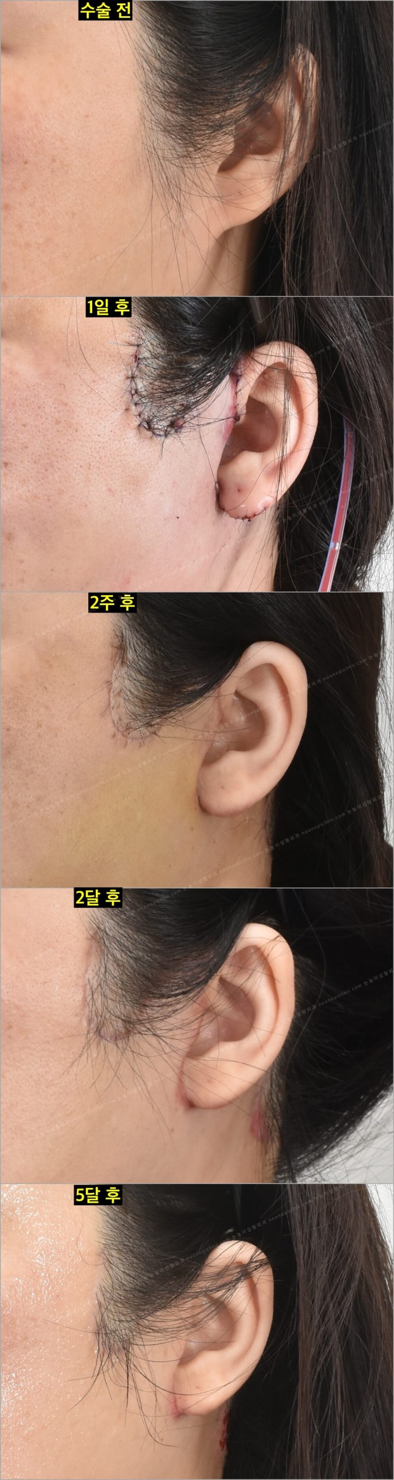 Facelift Scars and Recovery Time image 5