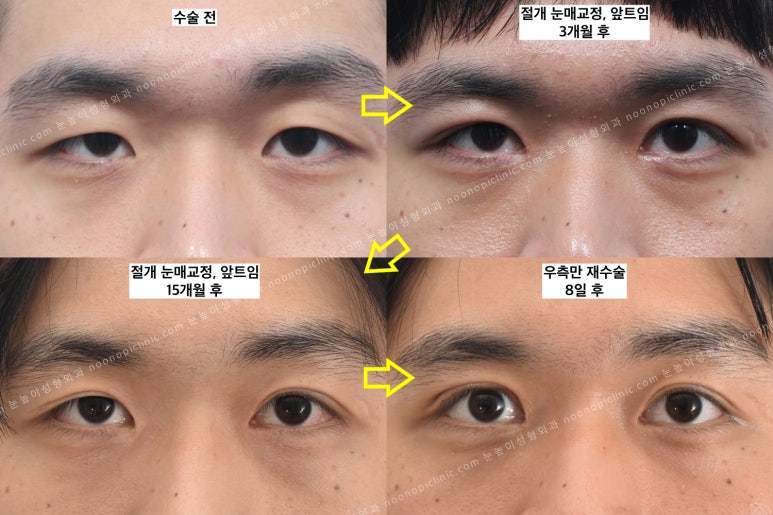 눈매교정 재수술 사례 : 고객과 합심해서 만든 결과 관련 이미지 6