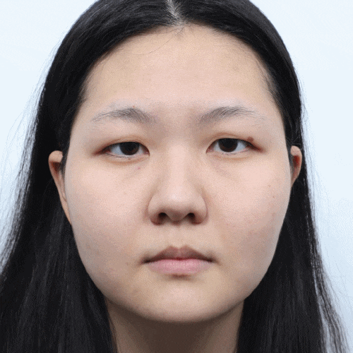 What Is Ptosis Correction? (Graphic Images Warning ⚠️) image 8