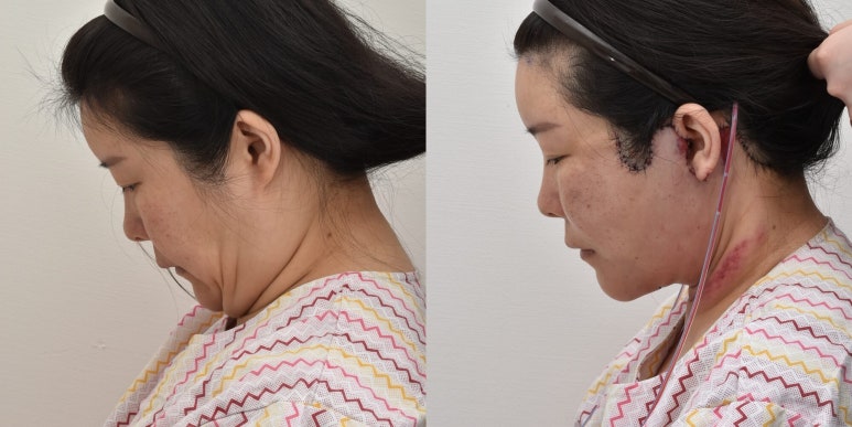 세상에서 가장 안면거상 수술을 잘하는 닥터 관련 이미지 24
