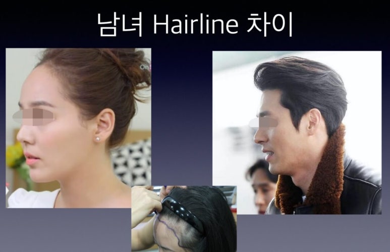 Forehead Reduction Surgery vs Hair Transplant image 4