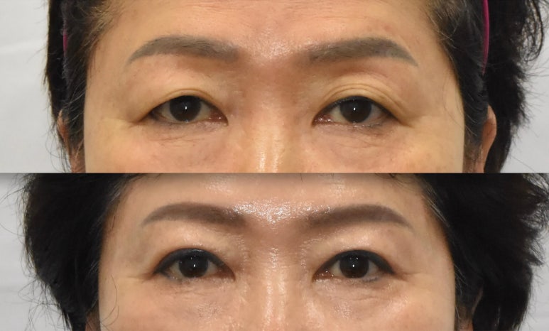 If You’re Looking Into Cosmetic Surgery as a Mother’s Day Gift for Your Parents image 2