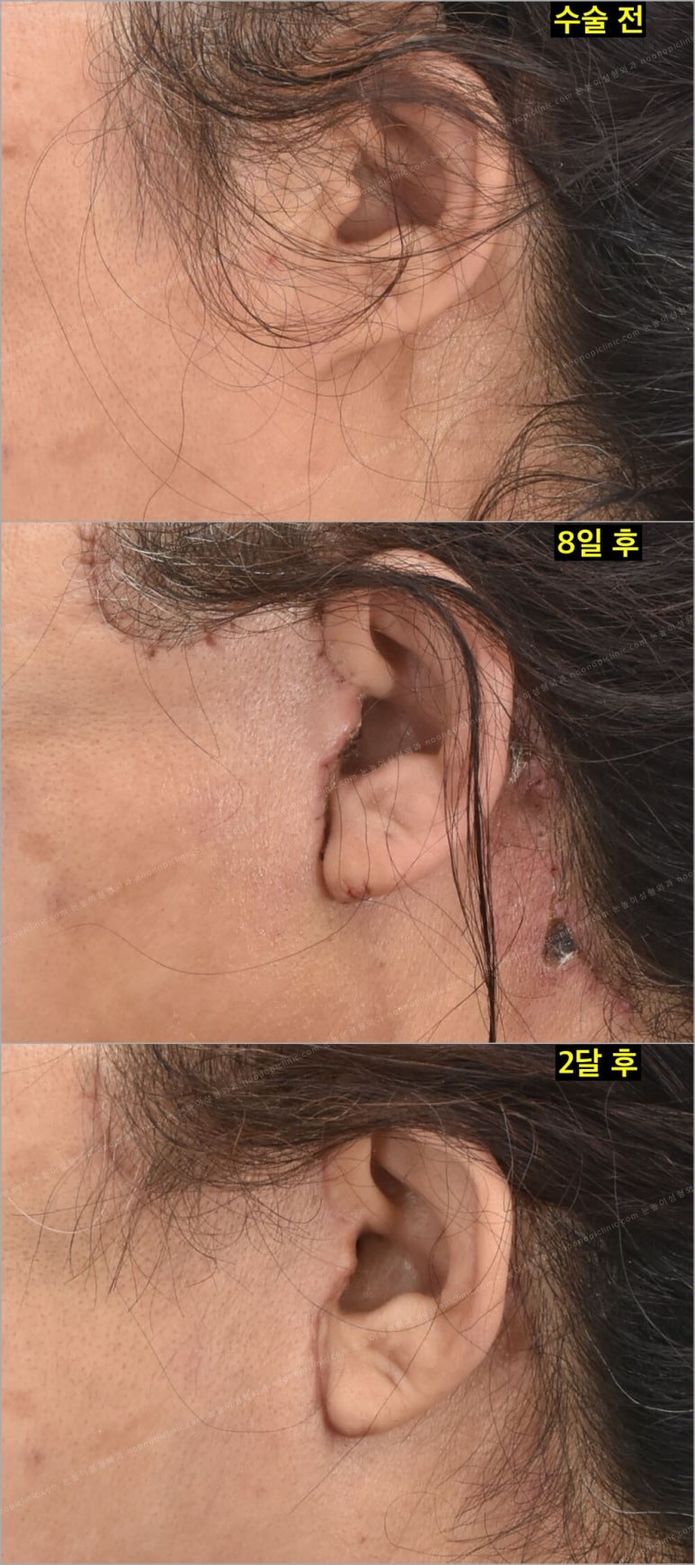 Facelift Scars and Recovery Time image 14