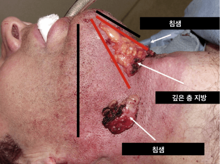 세상에서 가장 안면거상 수술을 잘하는 닥터 관련 이미지 12