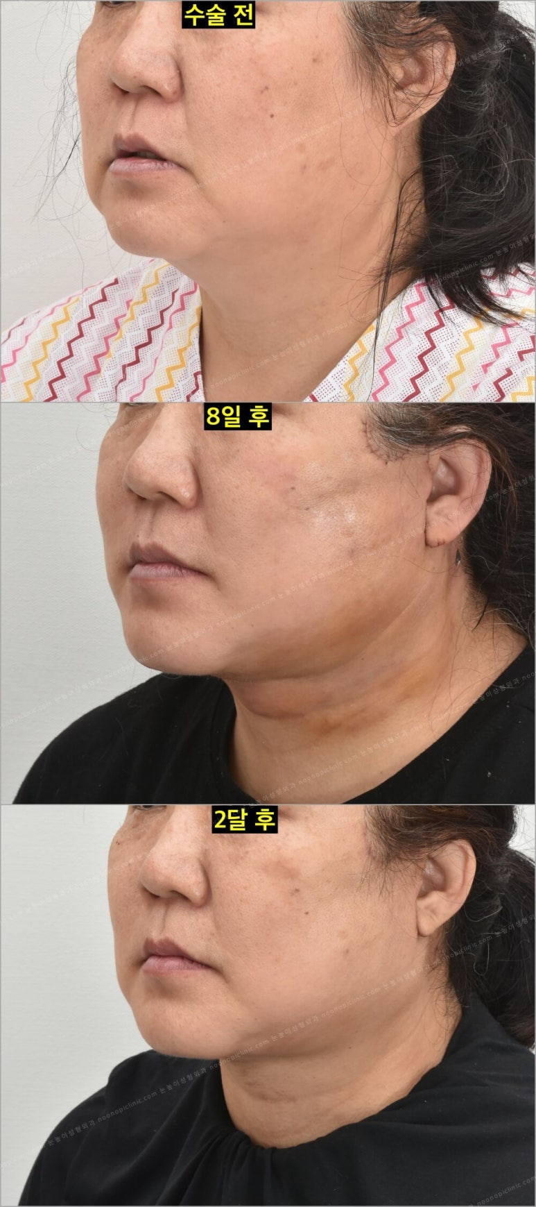 Facelift Scars and Recovery Time image 11