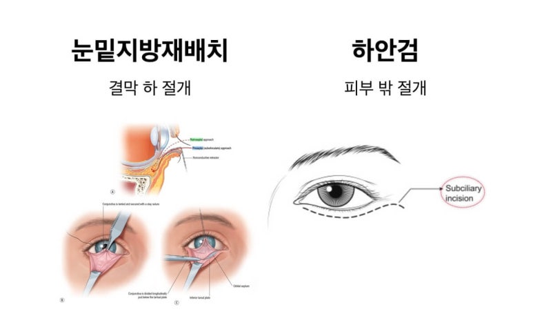 Lower Blepharoplasty vs. Fat Repositioning for Under-Eye Bags - Which Under-Eye Surgery Is Right for Me? image 3