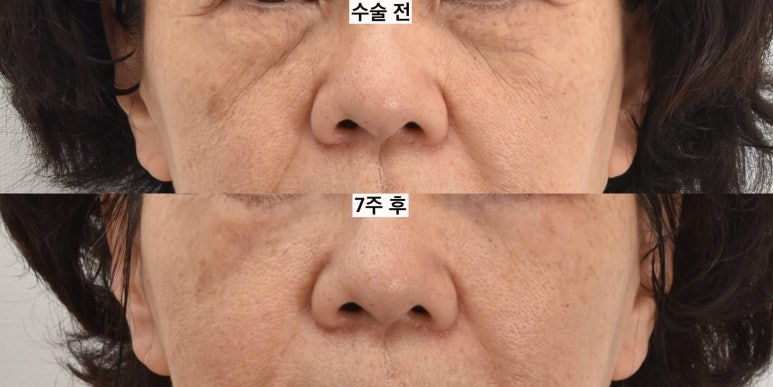 눈밑지방이식은 어떤 경우 하는 게 좋을까 관련 이미지 6