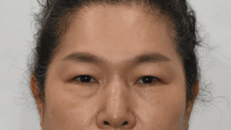 중년 눈수술! 사나워지자고 하는게 아니잖아요 :  조영구 성형에 관한 눈높이성형외과의 견해 관련 이미지 4