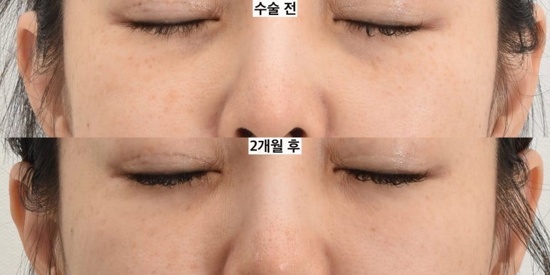 눈밑지방이식은 어떤 경우 하는 게 좋을까 관련 이미지 2