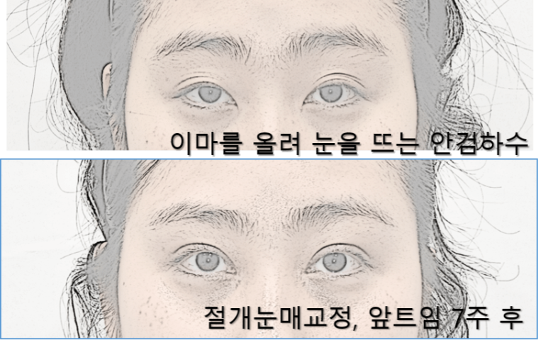 눈매교정과 쌍수 중 나에게 최선은? 관련 이미지 2