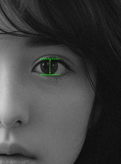 What Is Ptosis Correction? (Graphic Images Warning ⚠️) image 3