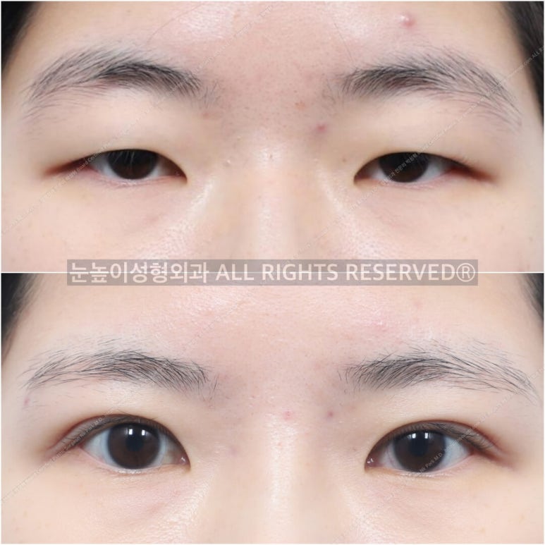 성형외과 전문의가 말하는 아름다운 눈이란 관련 이미지 4