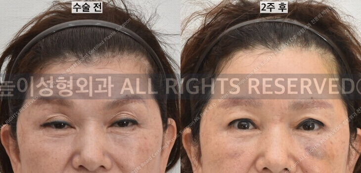 이마거상 비용과 부작용, 회복 과정에 대하여 관련 이미지 1