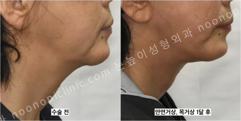 성형외과에서는 이중턱 리프팅을 이렇게 권한다(목거상수술) 관련 이미지 4