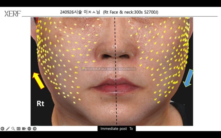 안면거상 후 세르프 리프팅은 언제부터 가능할까 관련 이미지 9
