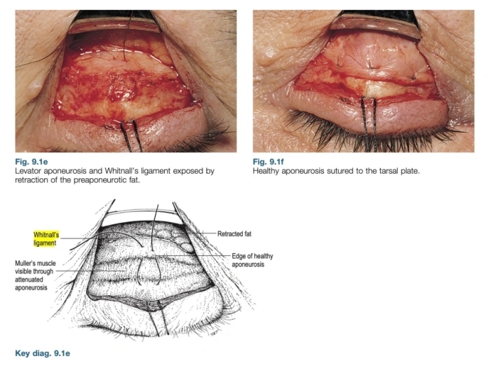 What Is Ptosis Correction? (Graphic Images Warning ⚠️) image 9