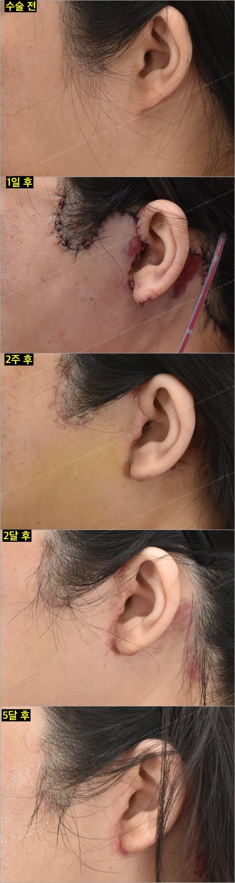Facelift Scars and Recovery Time image 3