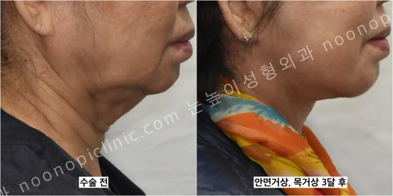 성형외과에서는 이중턱 리프팅을 이렇게 권한다(목거상수술) 관련 이미지 10