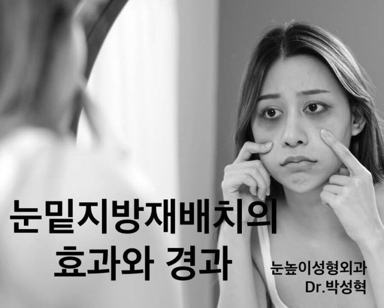 40대 눈밑지방재배치술 효과, 경과 관련 이미지 1