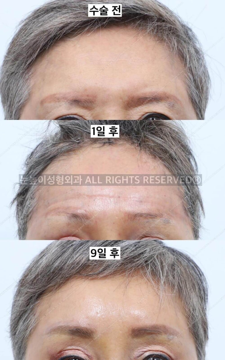 이마거상 비용과 부작용, 회복 과정에 대하여 관련 이미지 18