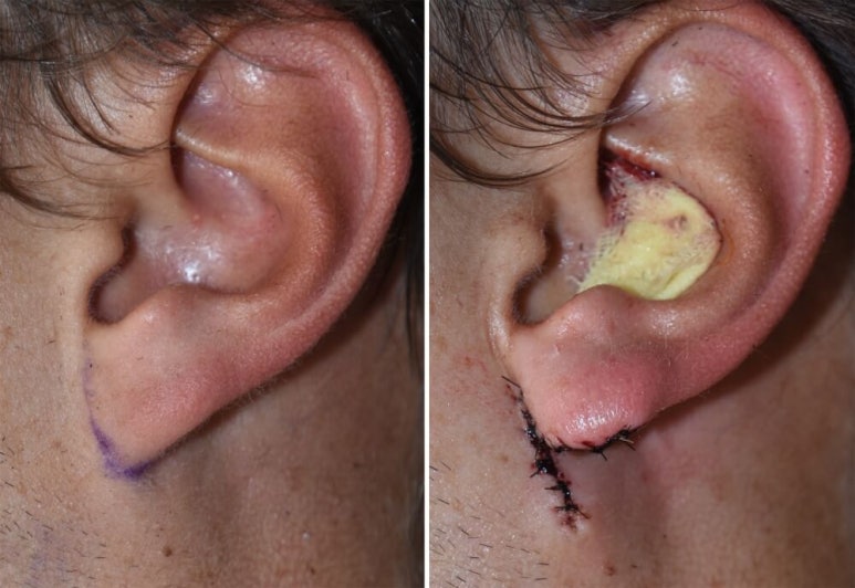 Facelift Scars and Recovery Time image 18