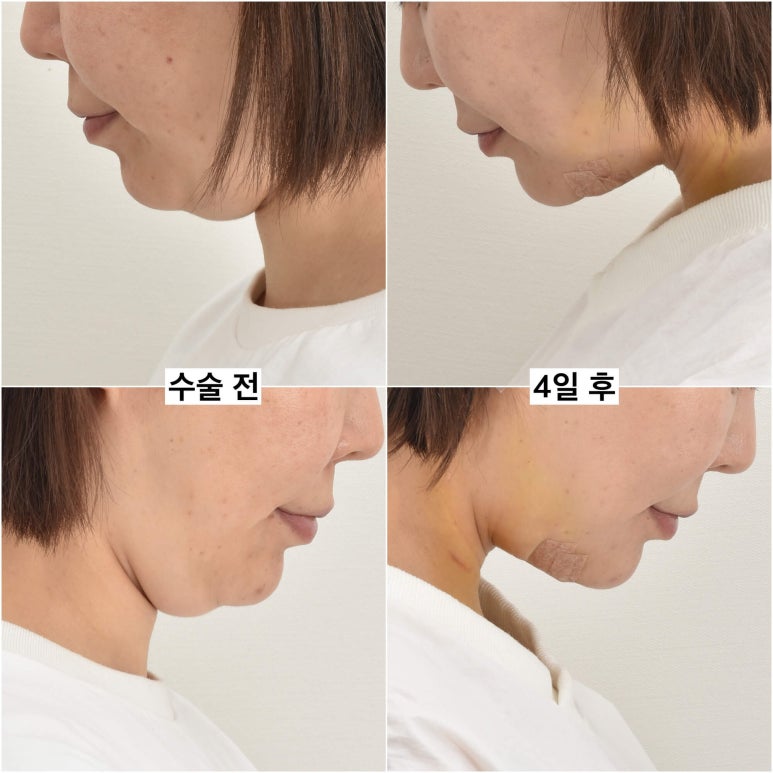 세상에서 가장 안면거상 수술을 잘하는 닥터 관련 이미지 19