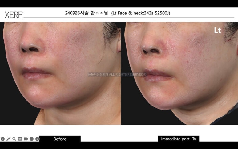 안면거상 후 세르프 리프팅은 언제부터 가능할까 관련 이미지 14