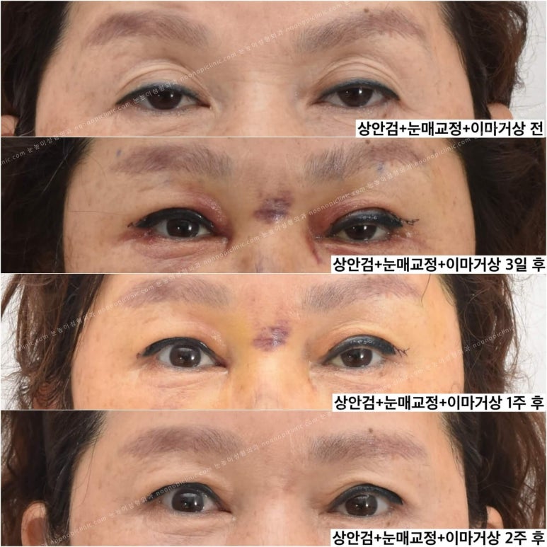 상안검수술하려는데 안검하수가 웬 말? 관련 이미지 12