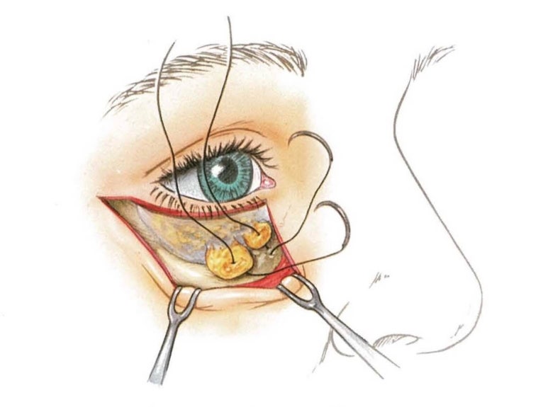 Lower Blepharoplasty vs. Fat Repositioning for Under-Eye Bags - Which Under-Eye Surgery Is Right for Me? image 16
