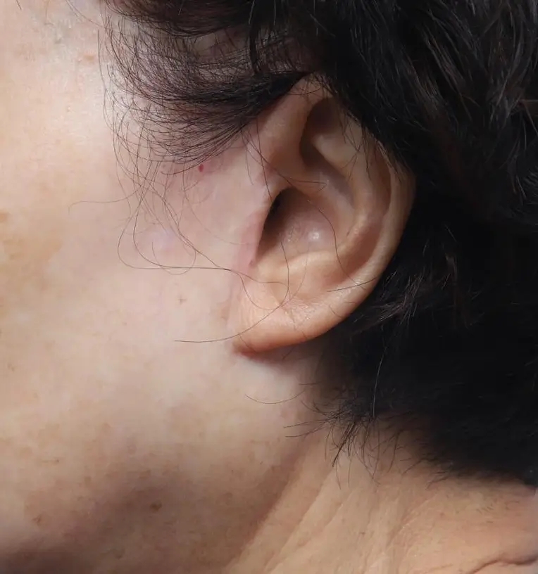 안면거상술, 흉터까지 고려하고 계신가요? 관련 이미지 9