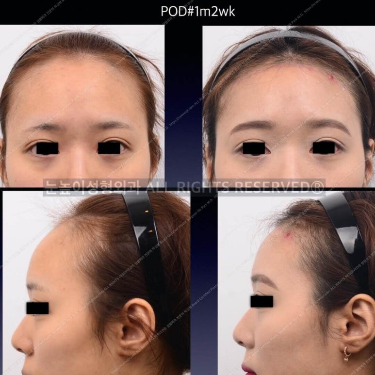 Forehead Reduction Surgery vs Hair Transplant image 10