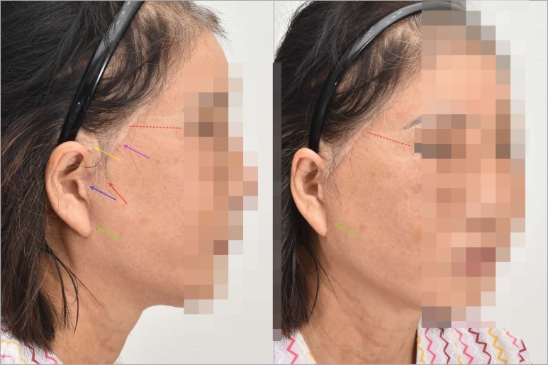 10 Things to Note About Facelift Results and Successful Before-and-After Cases image 4