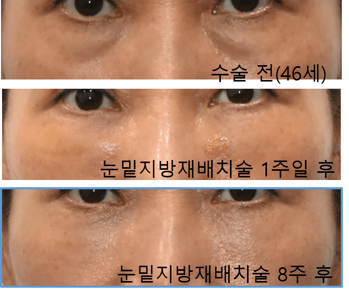 40대 눈밑지방재배치술 효과, 경과 관련 이미지 3