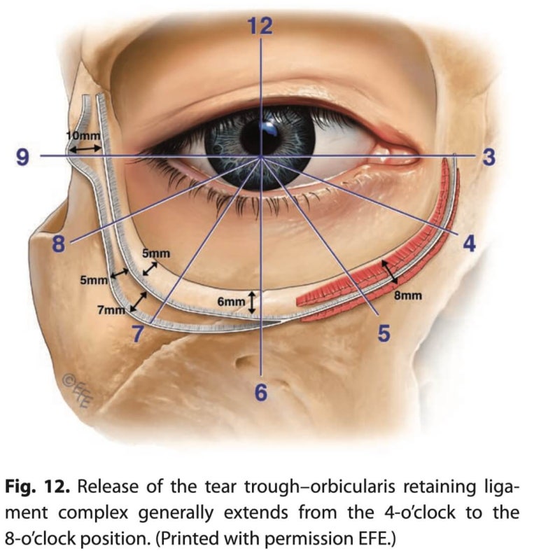 Lower Blepharoplasty vs. Fat Repositioning for Under-Eye Bags - Which Under-Eye Surgery Is Right for Me? image 17