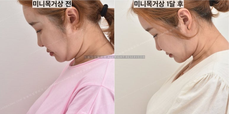 성형외과에서는 이중턱 리프팅을 이렇게 권한다(목거상수술) 관련 이미지 15
