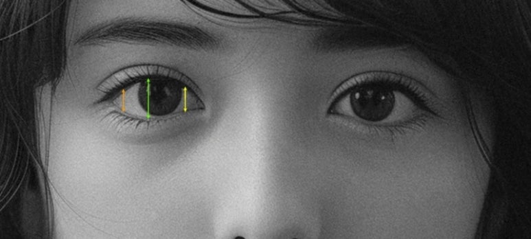 What Is Ptosis Correction? (Graphic Images Warning ⚠️) image 12