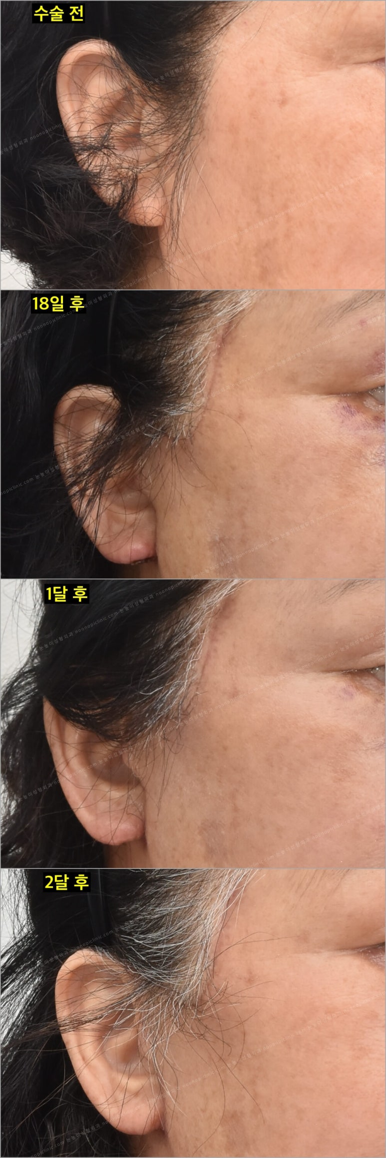 Facelift Scars and Recovery Time image 22