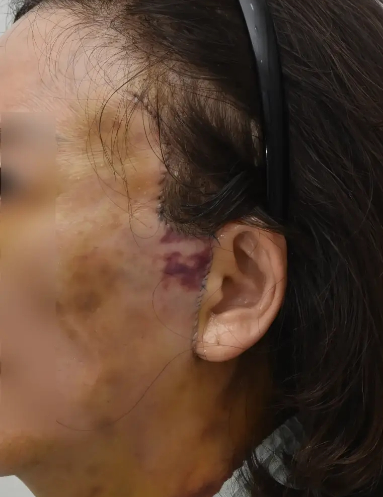 안면거상술, 흉터까지 고려하고 계신가요? 관련 이미지 6