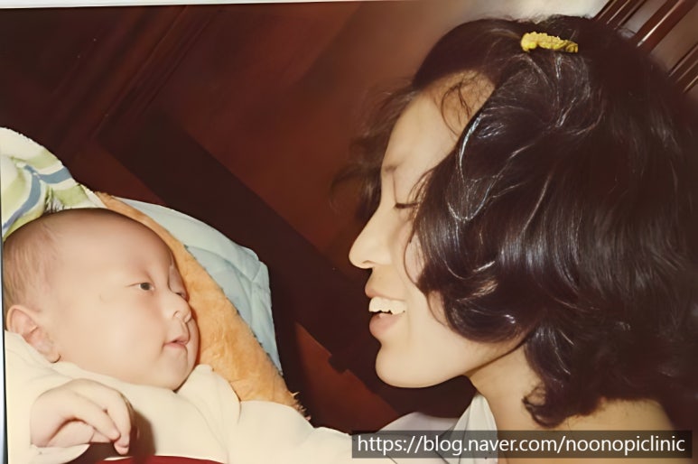 가족에게 추천한 눈밑하안검수술 24개월 경과 관련 이미지 1