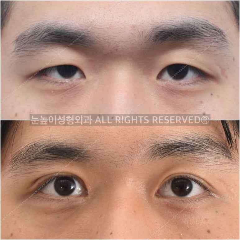 성형외과 전문의가 말하는 아름다운 눈이란 관련 이미지 5