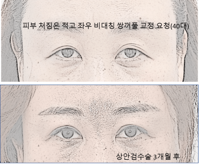 Do I Need Ptosis Correction When Getting Upper Blepharoplasty? image 4
