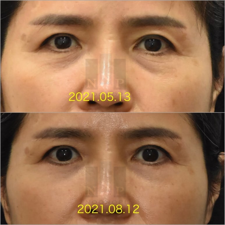 Lower Blepharoplasty vs. Fat Repositioning for Under-Eye Bags - Which Under-Eye Surgery Is Right for Me? image 13