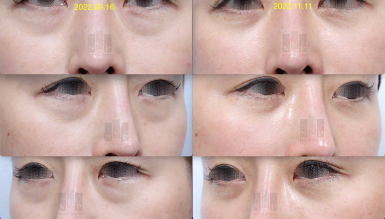 Lower Blepharoplasty vs. Fat Repositioning for Under-Eye Bags - Which Under-Eye Surgery Is Right for Me? image 4