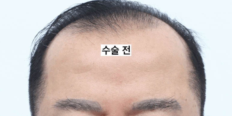 Brow Lift Scars and Hair Loss image 4