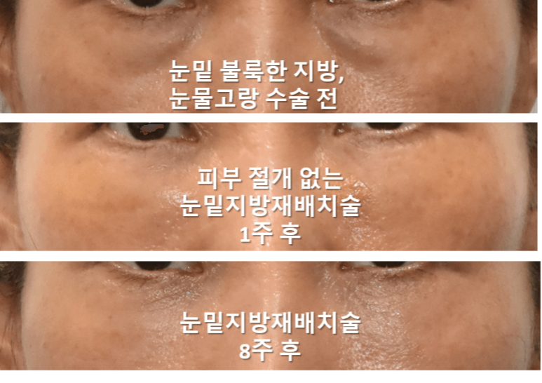 눈밑지방이식 어떤 경우에 효과적일까? 과도함, 부작용 방지 위해 관련 이미지 2